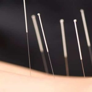 Acupuncture in London