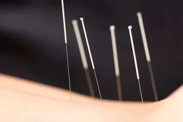 Acupuncture in London
