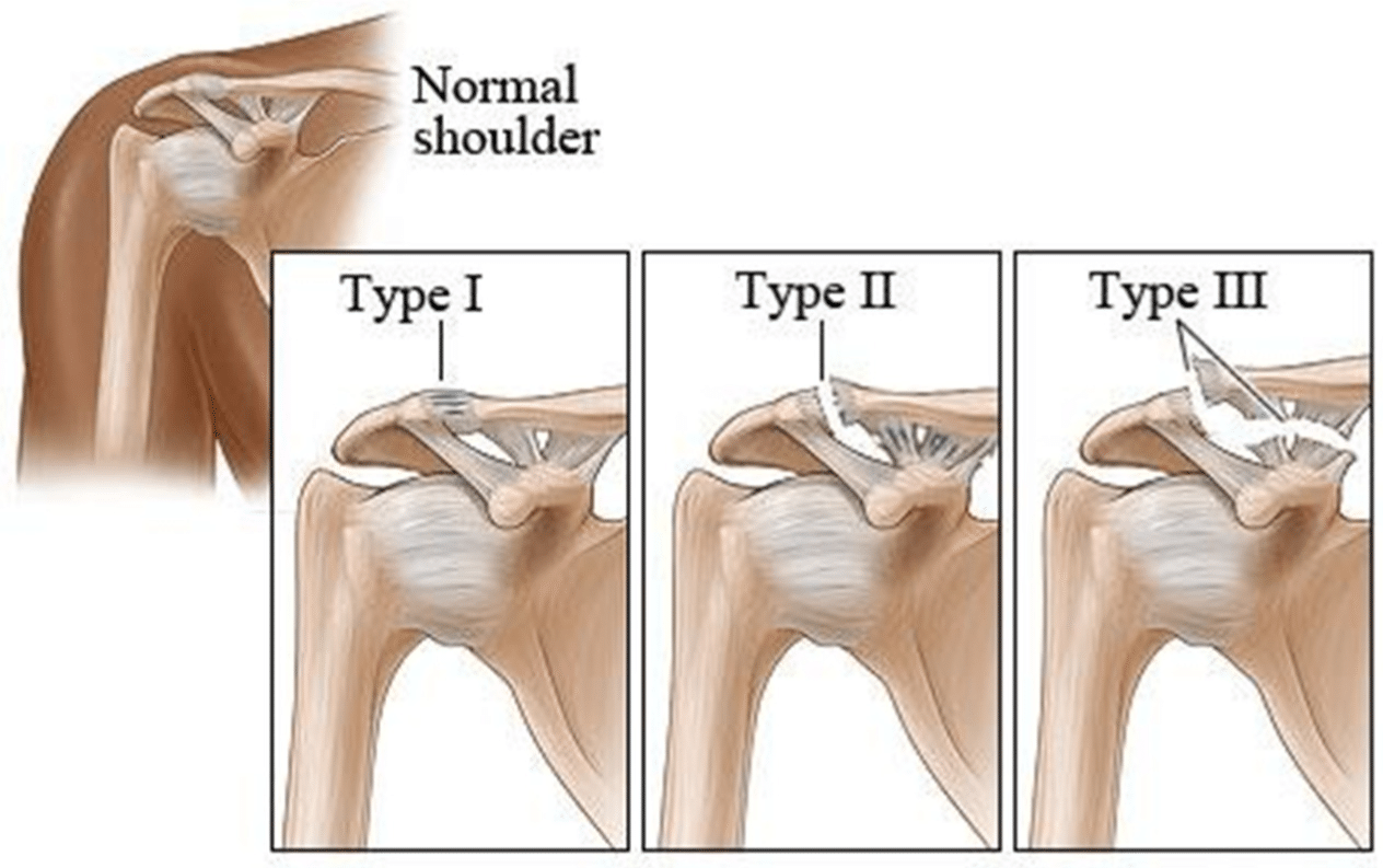 Acromioclavicular (AC) joint: Anatomy, function