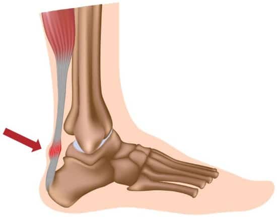 Achilles Tendinopathy Achilles Tendinopathy Treatment in Twyford - Main Image